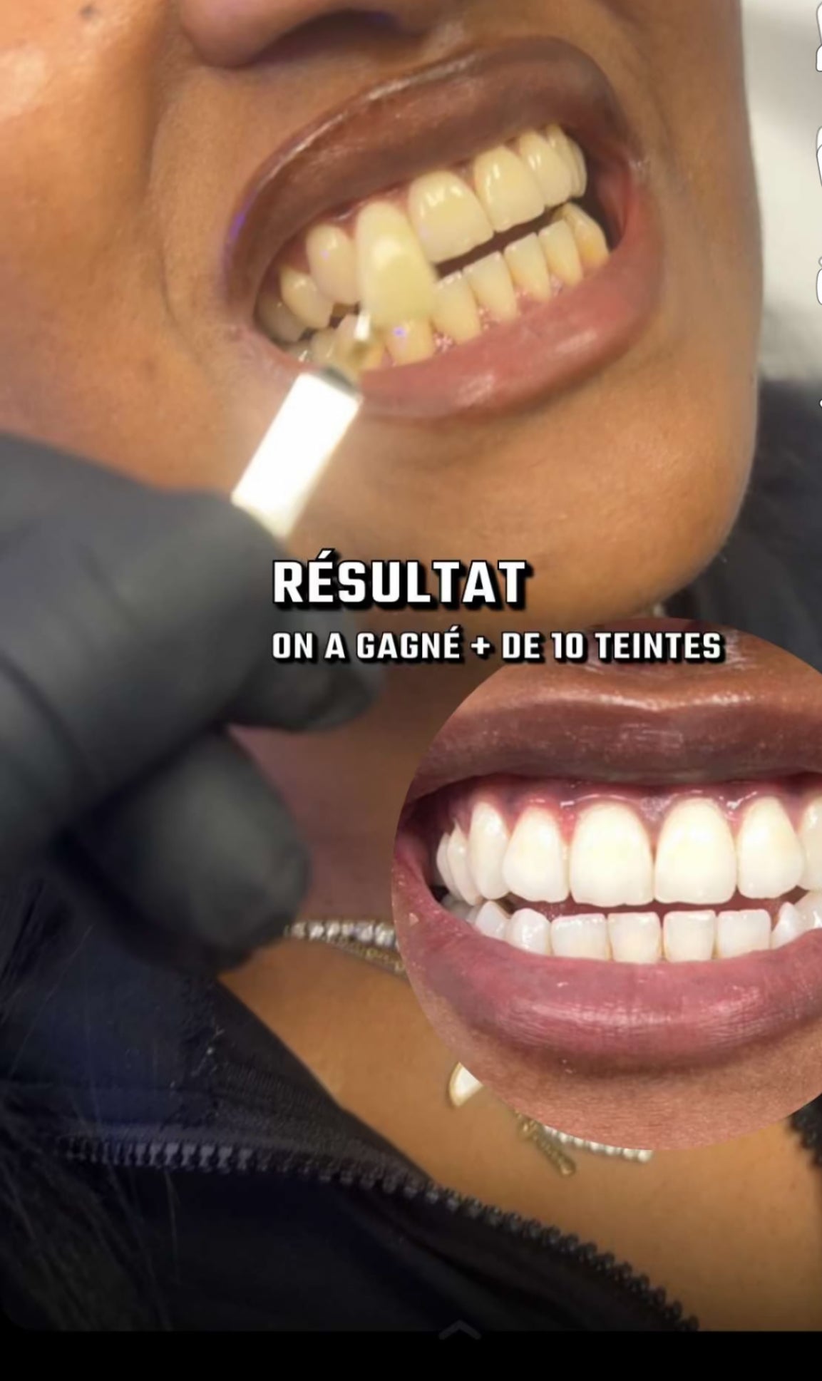 Formation technicien blanchiment dentaire américain - avec ou sans kit complet - 1 jour